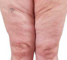 Lipedema