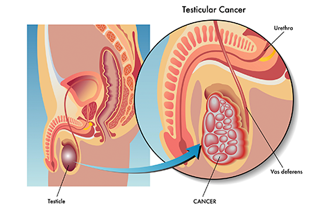 cancer renal